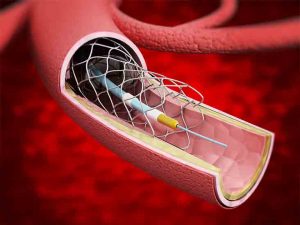 stent_thumb-300x225.jpg