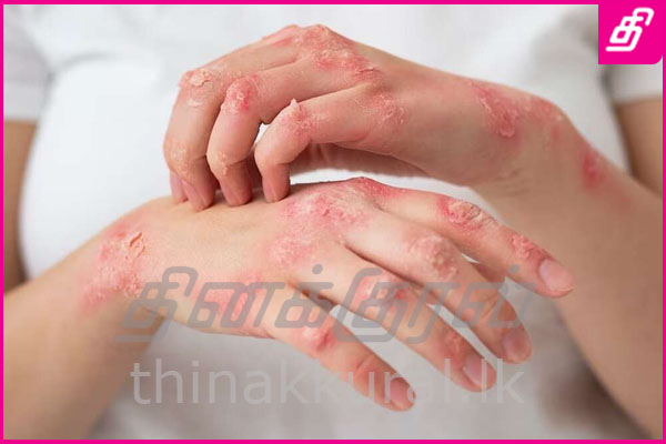 tinea-infection.jpg